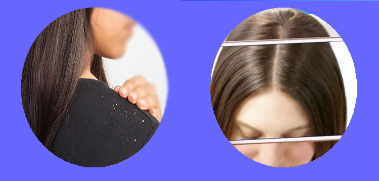 How To get rid of dandruff naturally