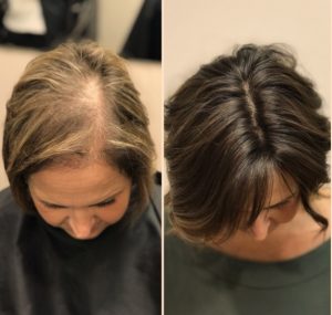 Thinning Hair on Top of Head Female