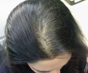 female pattern baldness pictures