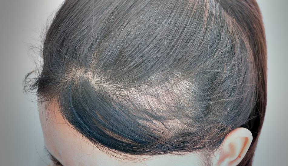 How to Regrow Bald Spots in Black Hair