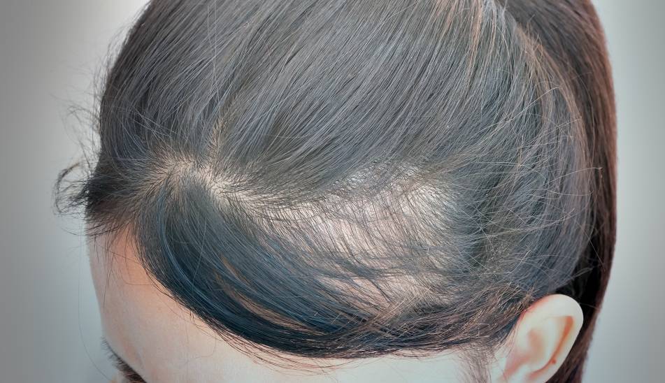 How To Regrow Bald Spots In Black Hair Okaylifes