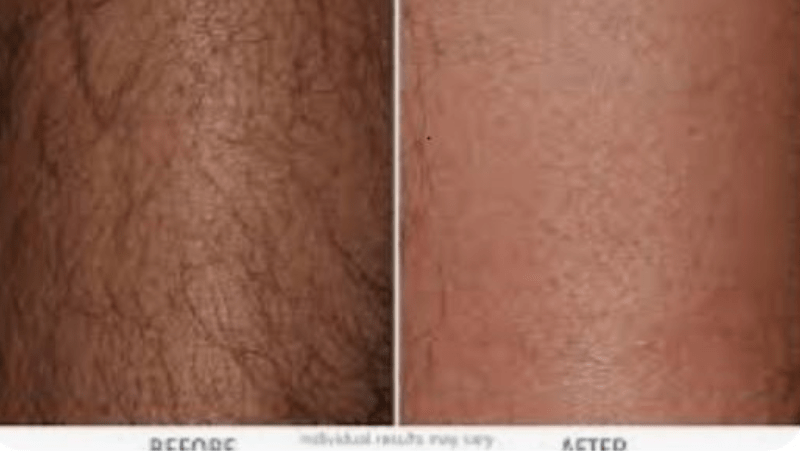 Laser hair removal results after first treatment